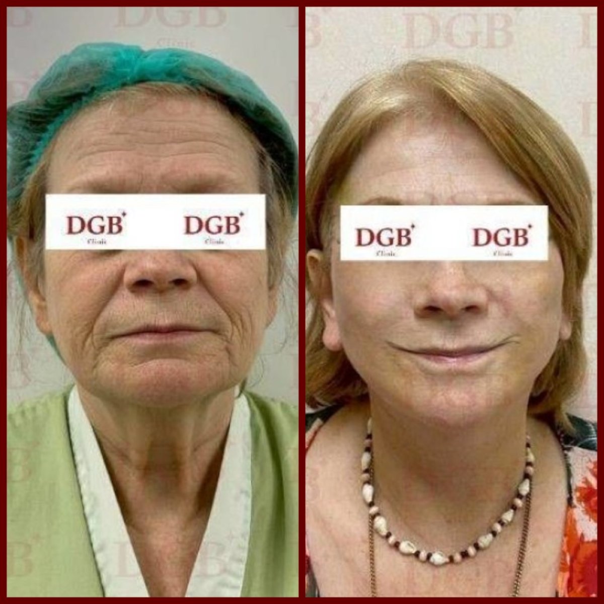 Результати до і після deep plane підтяжки обличчя в DGB Clinic, омолодження