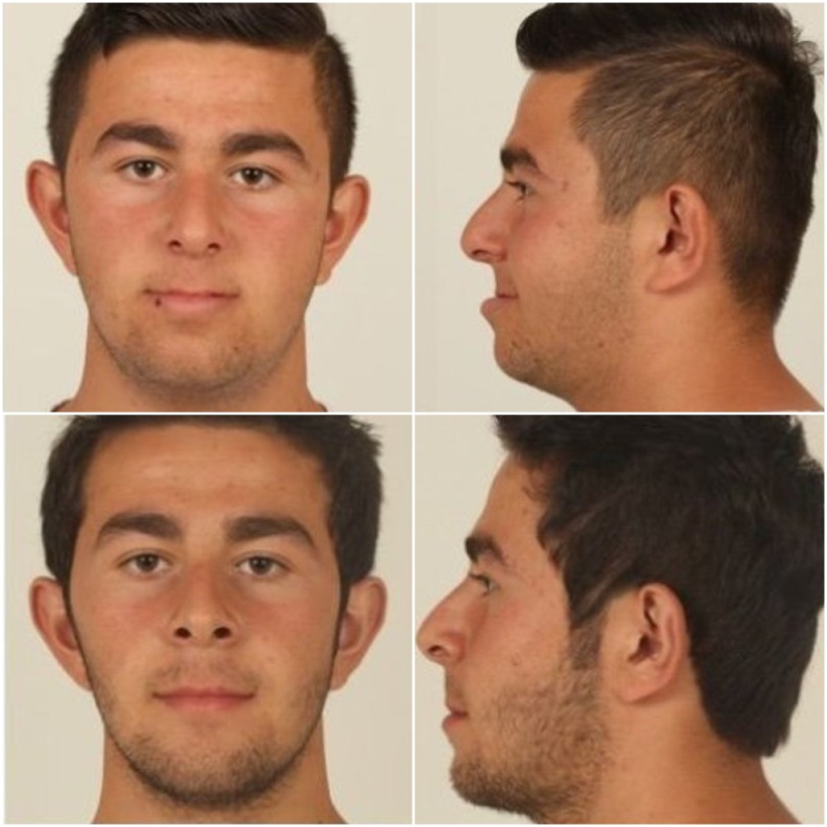 Resultados antes y después de perfilado de mandíbula en Prof. Dr. Furkan Karabekmez Ankara