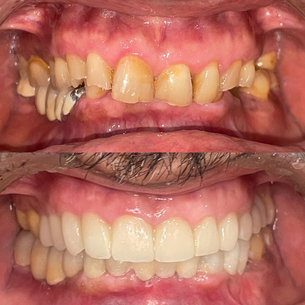 Before and after teeth cleaning (scaling) results – improved dental health and whiter smile