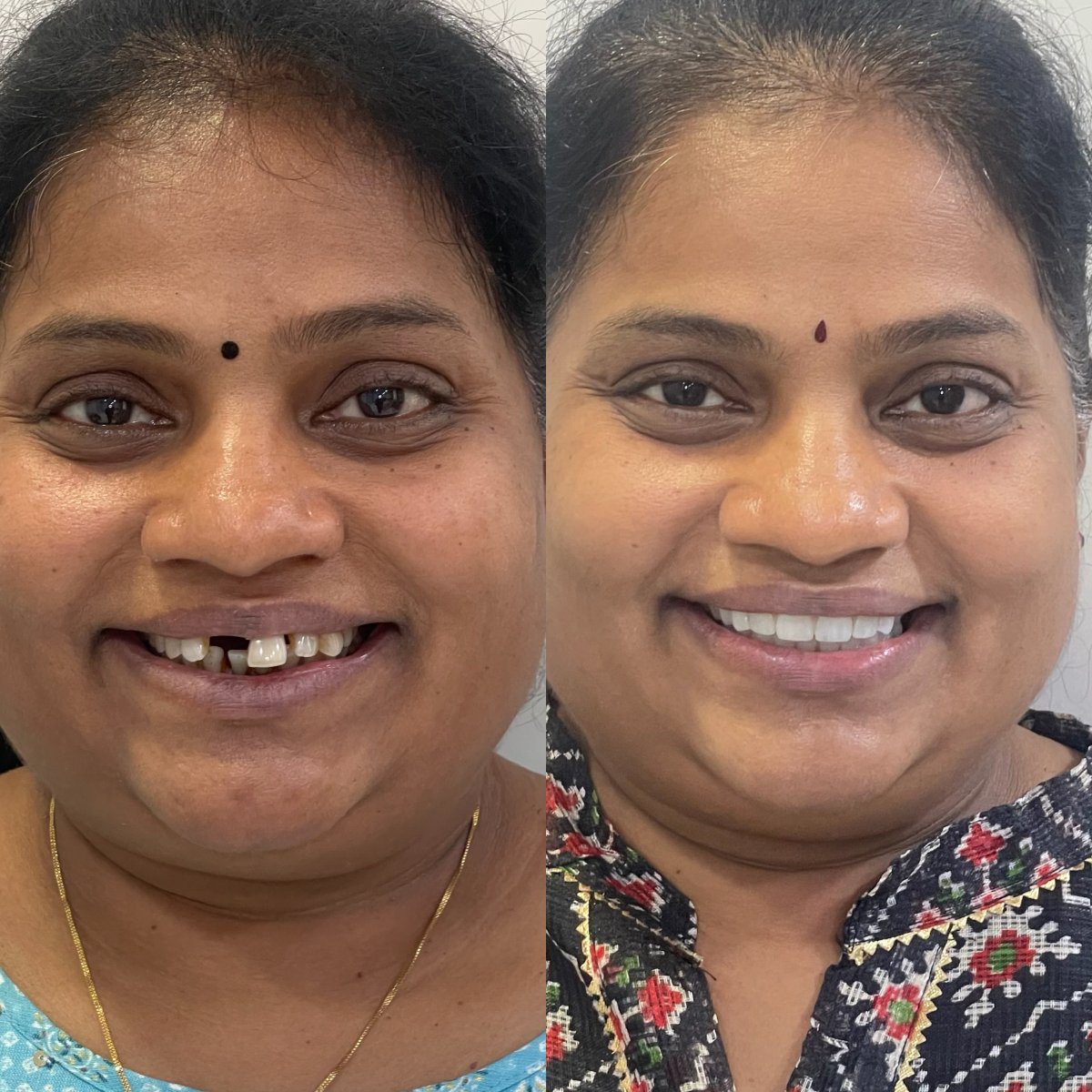 Результаты до и после smile makeover – восстановление зубов и выравнивание улыбки