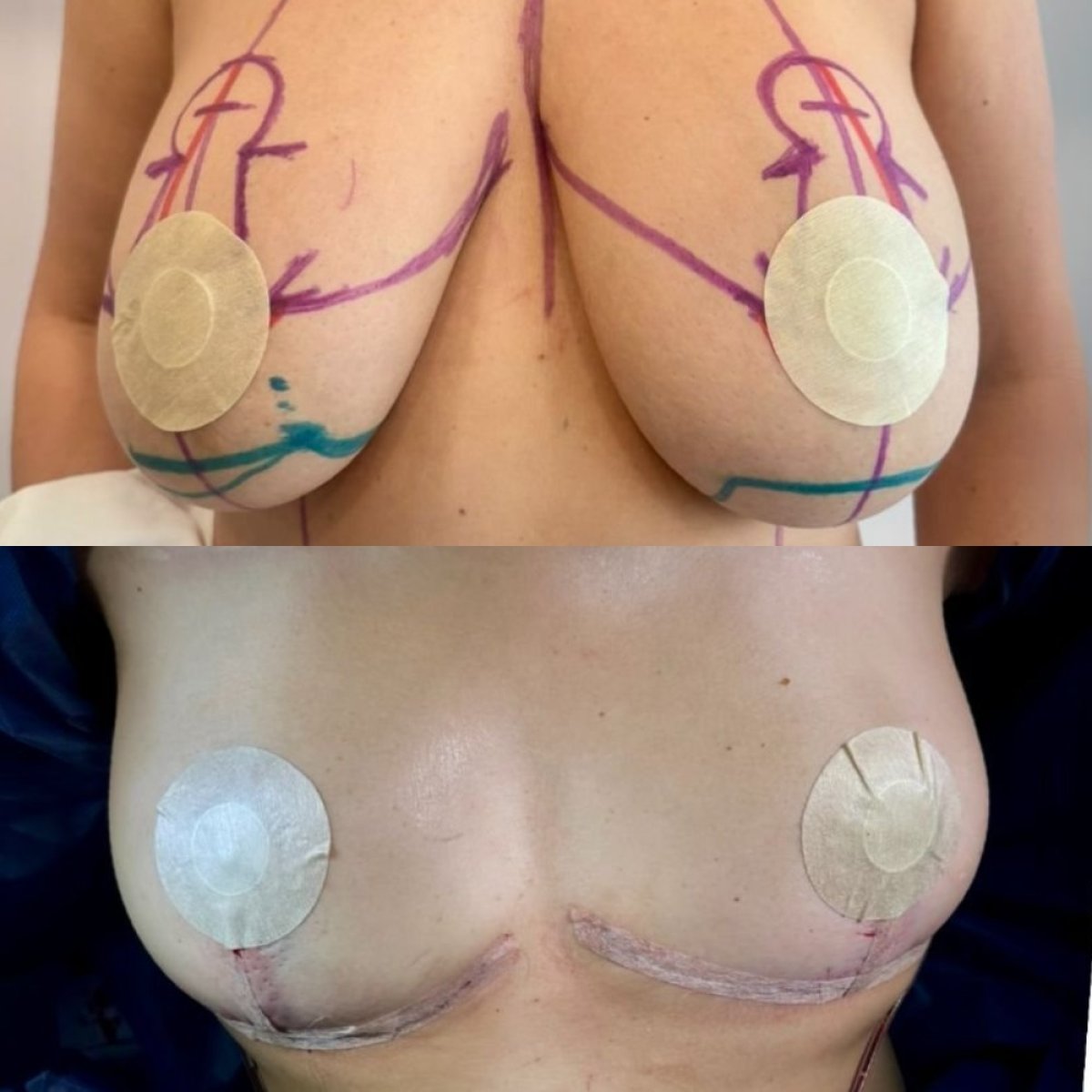 Résultats avant et après implants mammaires avec lifting, forme et contour améliorés