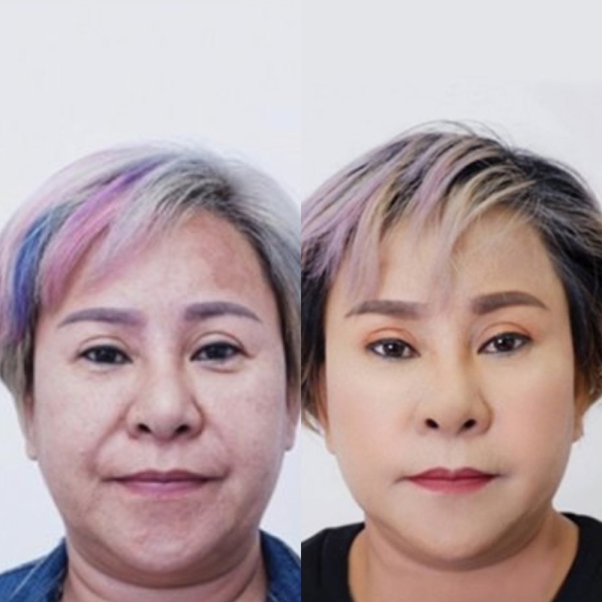Before and after facelift results at Asia Cosmetic Hospital, visible facial rejuvenation