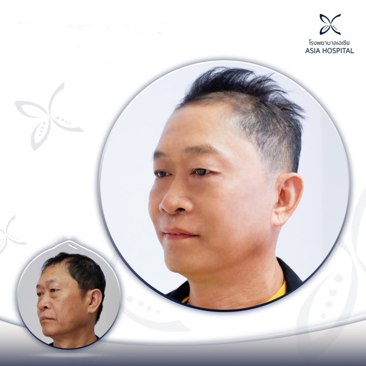 Facelift before and after results at Asia Cosmetic Hospital, visible facial rejuvenation