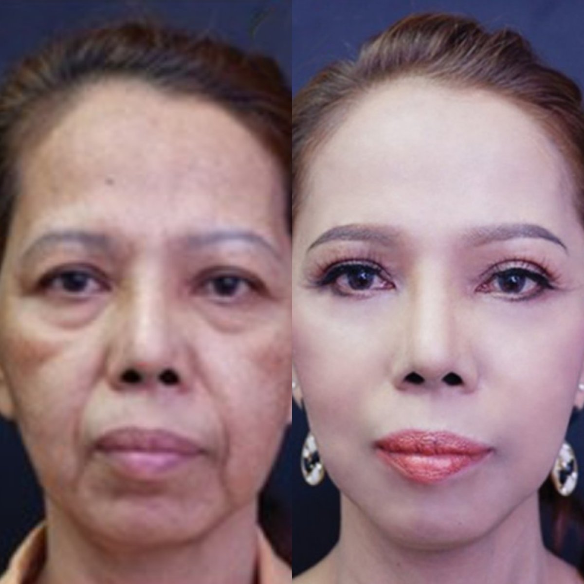 Before and after facelift results at Asia Cosmetic Hospital, facial rejuvenation and tighter skin