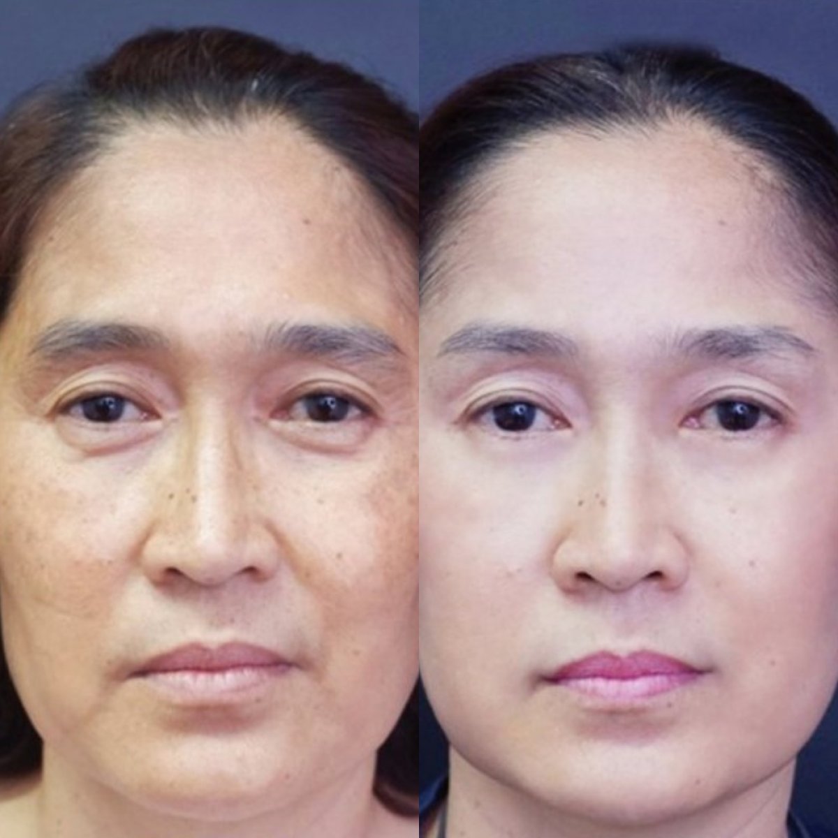 Facelift before and after results at Asia Cosmetic Hospital, visible facial rejuvenation outcome