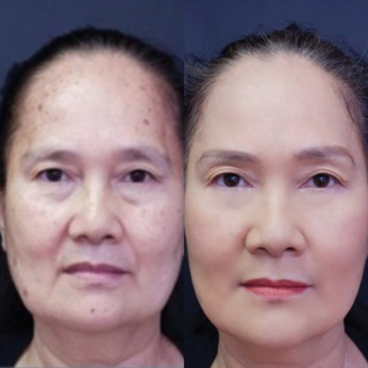 Facelift before and after results at Asia Cosmetic Hospital, visible facial rejuvenation effect