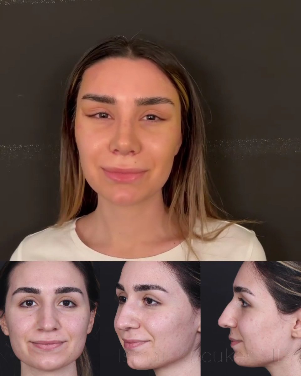 Before and after rhinoplasty results, nose reshaping for improved facial harmony