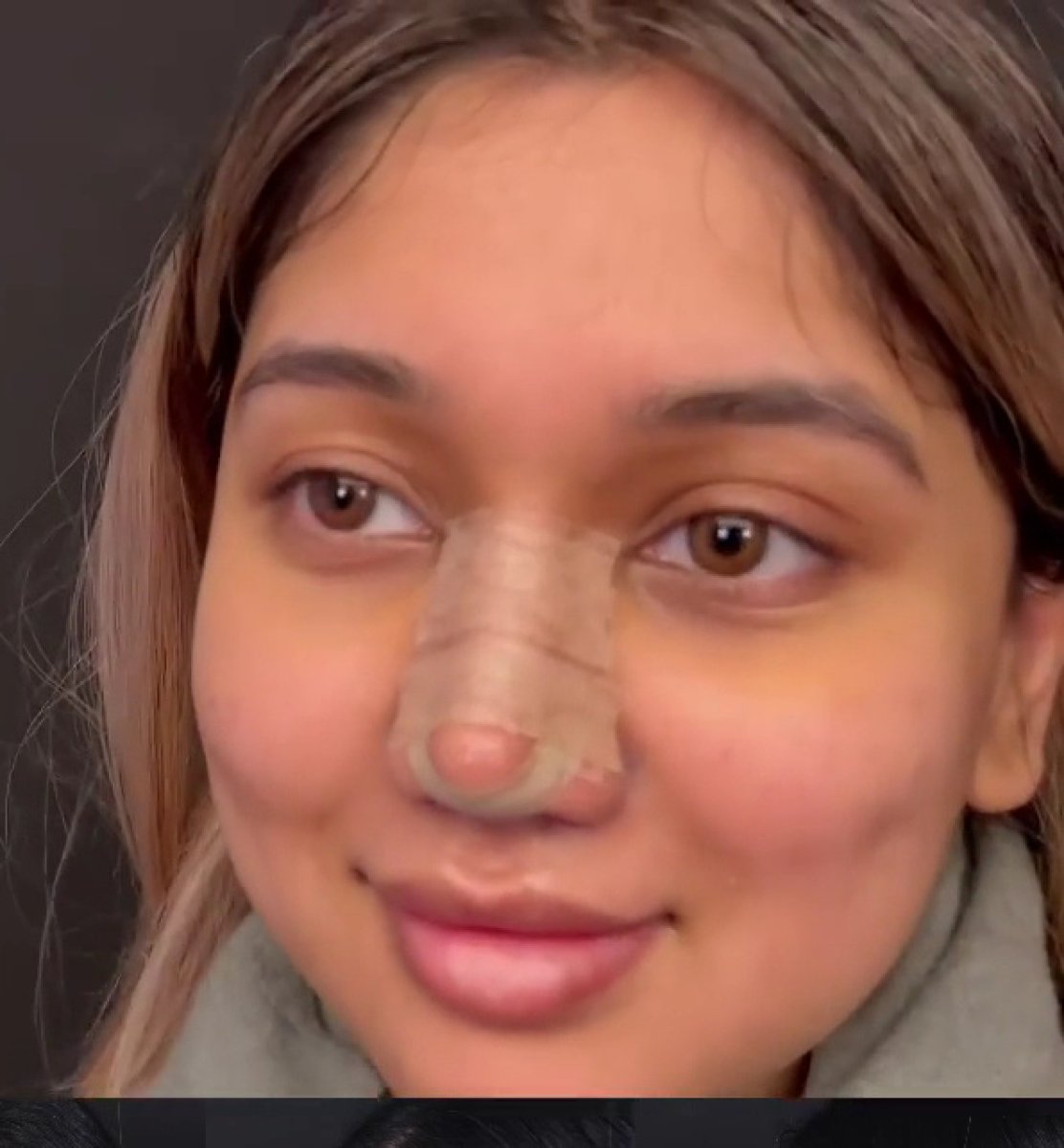 Resultado de rinoplastia con nariz vendada tras cirugía, cambio visible en la forma