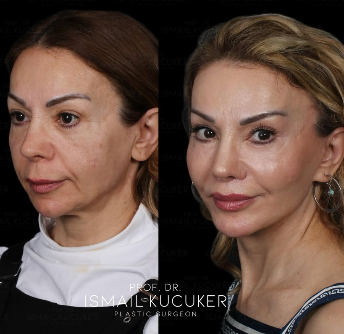 Facelift before and after results at Ismail Kucuker clinic, visible facial rejuvenation