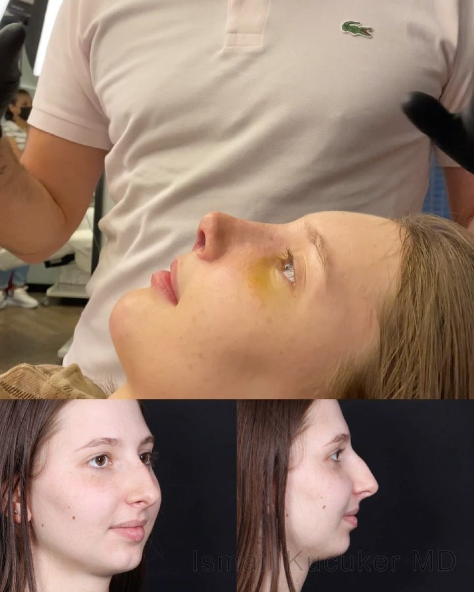 Before and after rhinoplasty results, nose reshaping for improved profile and facial harmony