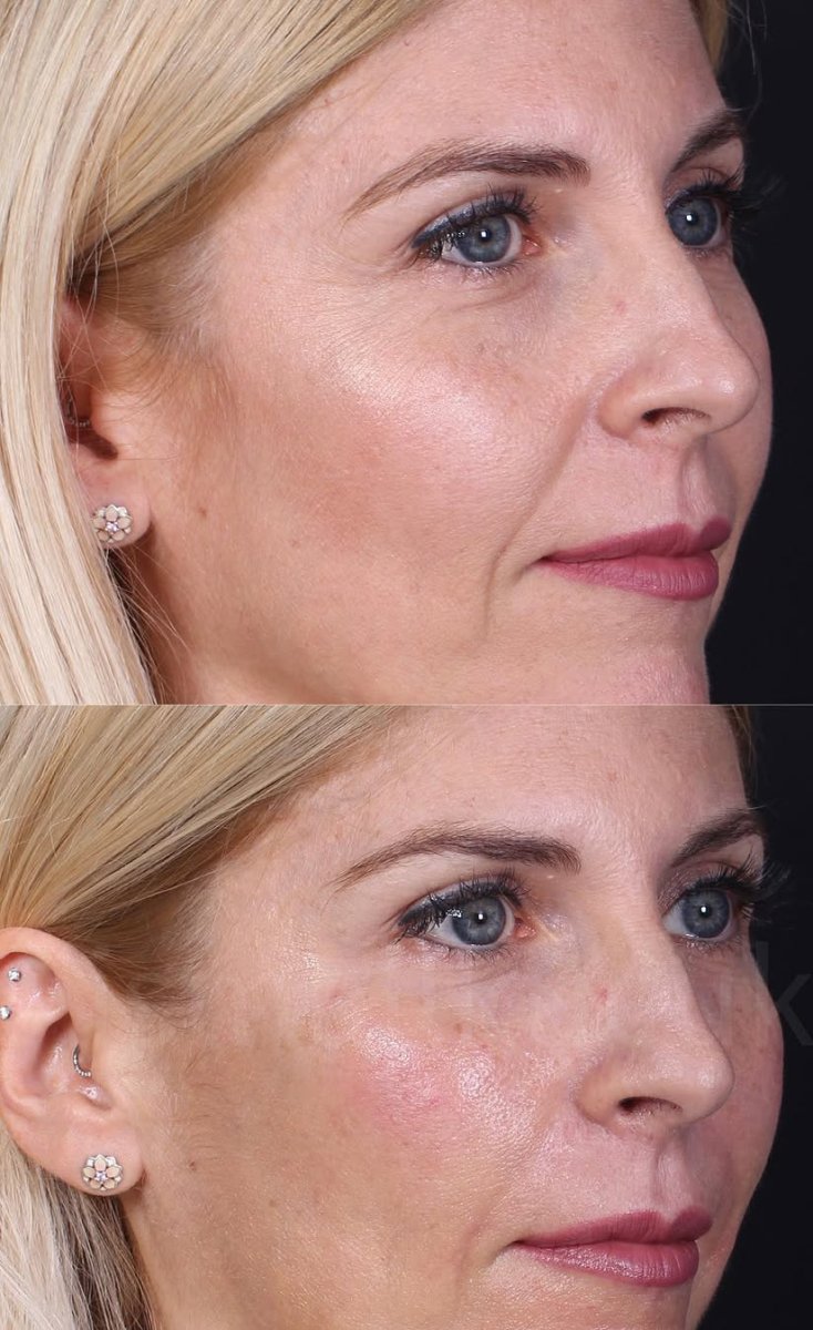 Before and after fillers injection results – smoother, rejuvenated skin on female face
