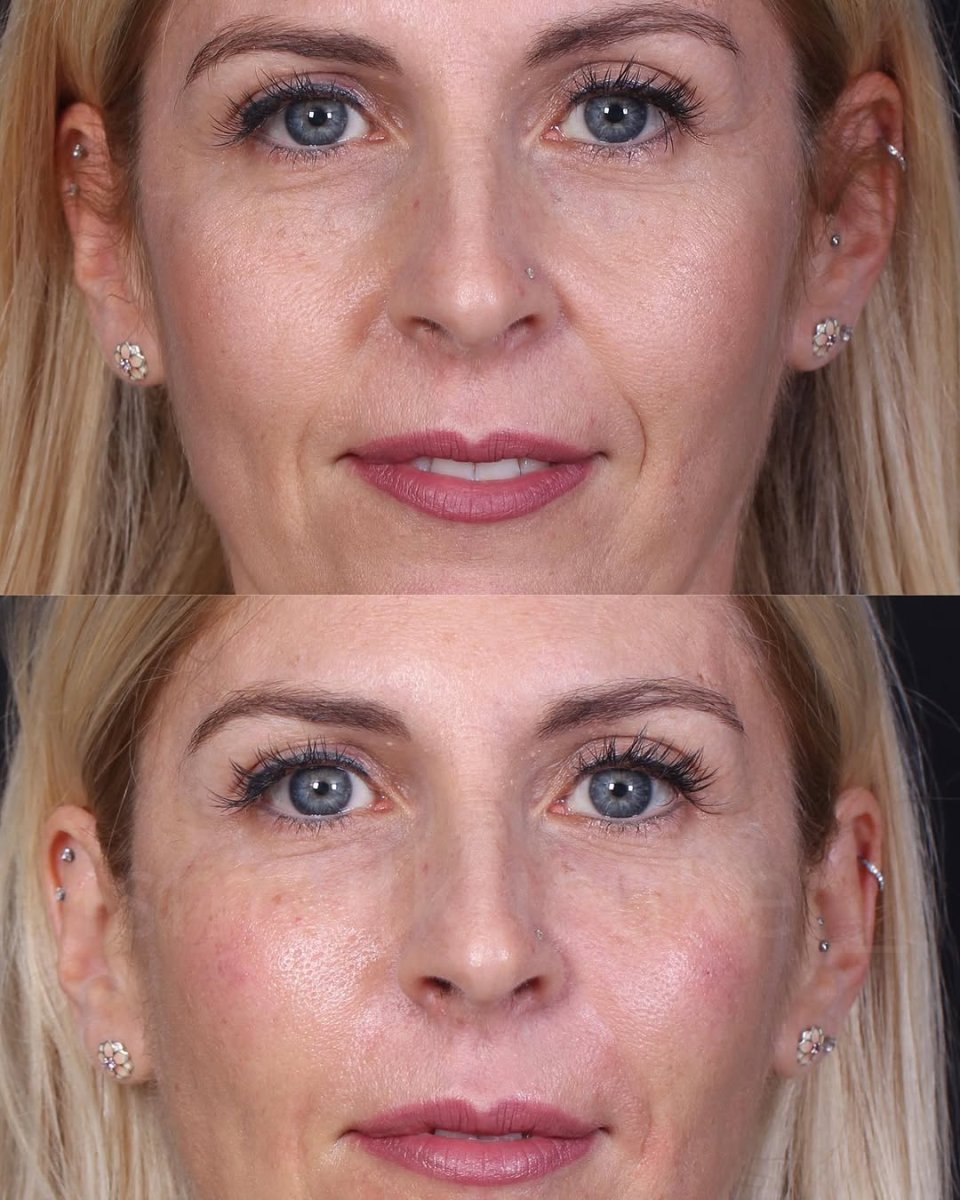 Resultado antes y después de rellenos dérmicos – piel facial más suave y menos arrugas