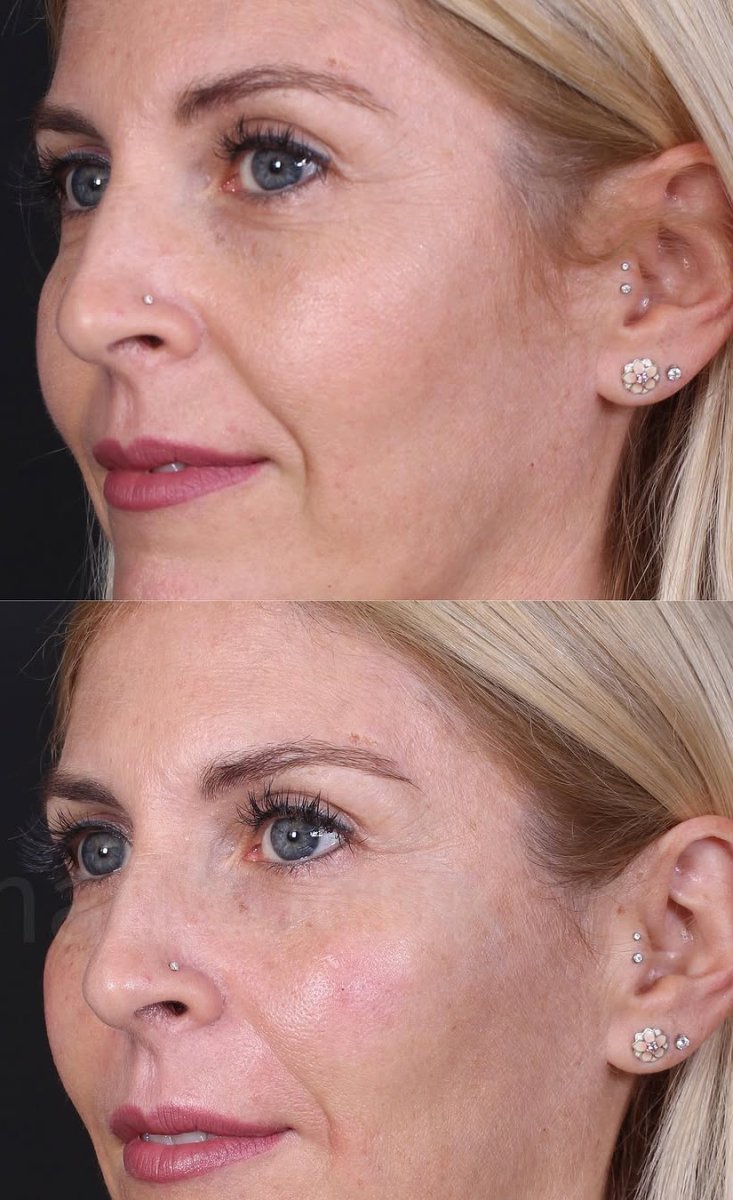 Resultados antes y después de rellenos dérmicos: piel suave y mayor volumen facial