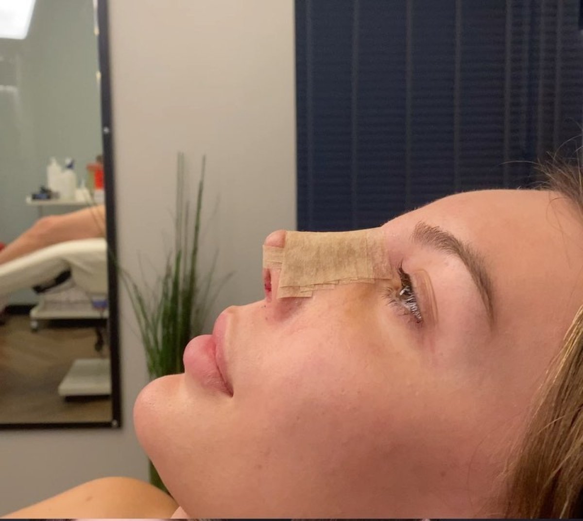 Resultado de rinoplastia abierta con vendaje nasal, recuperación postoperatoria en clínica