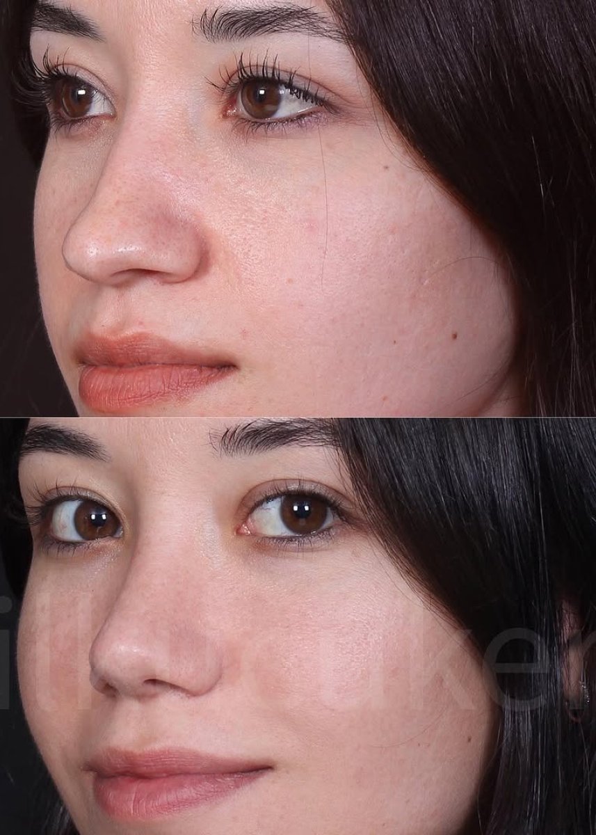 Resultados antes y después de rinoplastia abierta, remodelación nasal natural