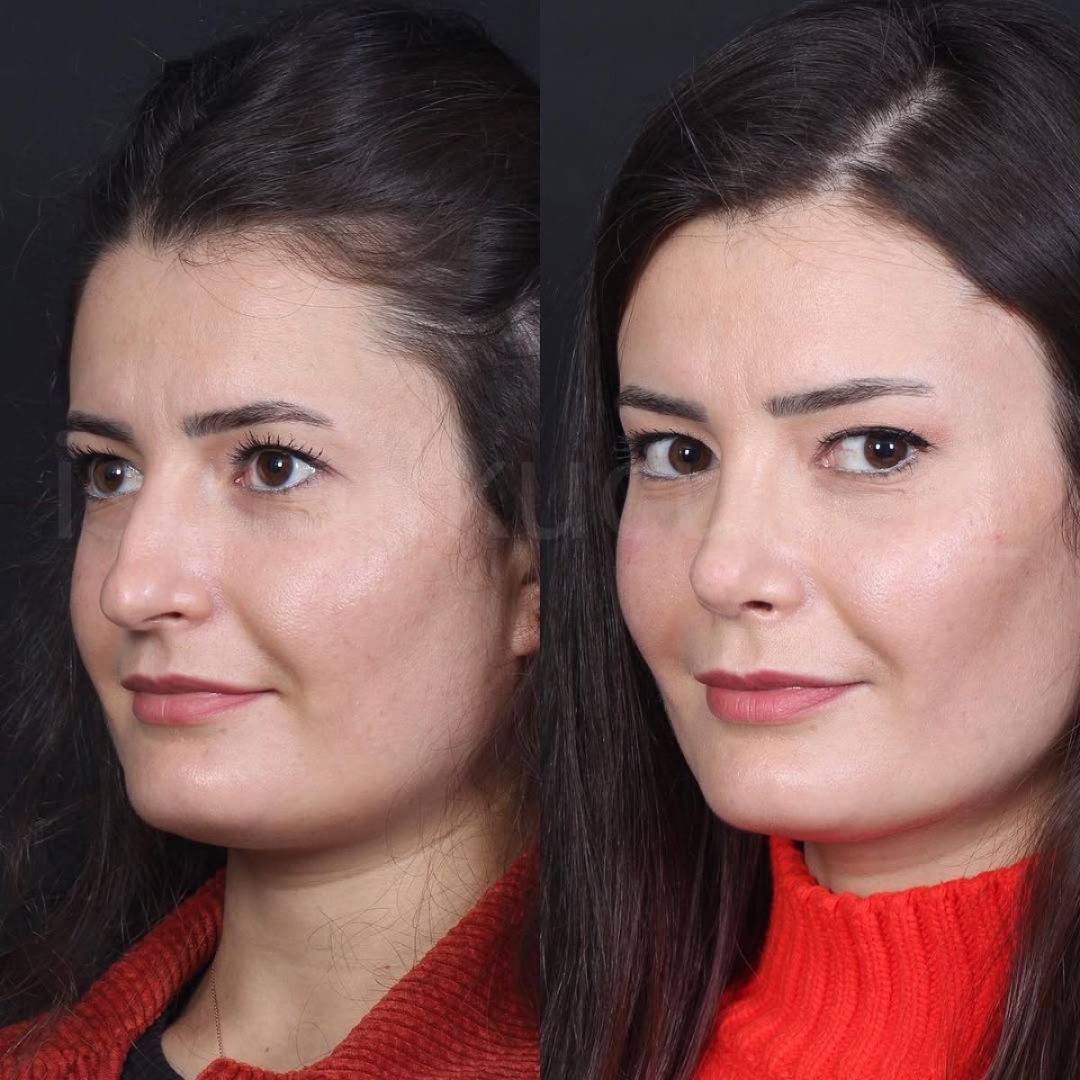 Before and after open rhinoplasty results, nose reshaping with natural look