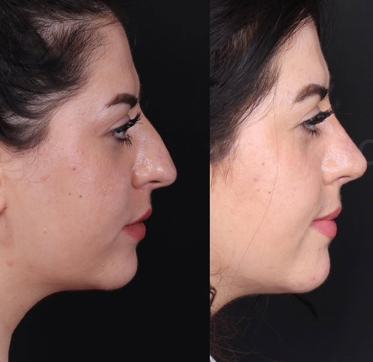 Before and after open rhinoplasty results, nose reshaping with natural profile improvement