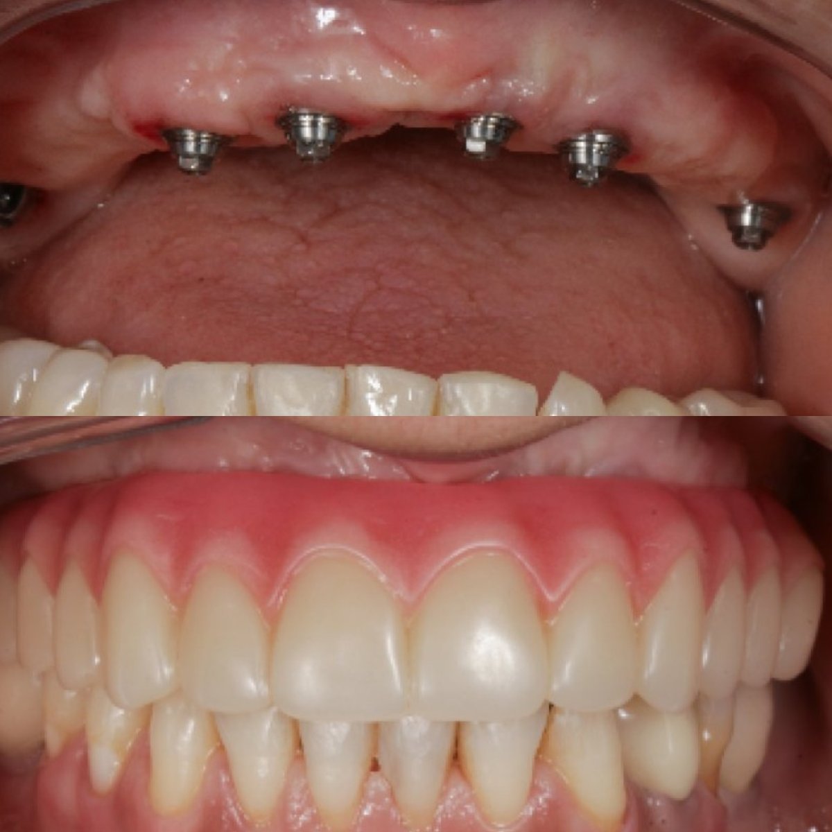 Resultados antes y después de implantes dentales All-on-6 en Clínica Zago, restauración total