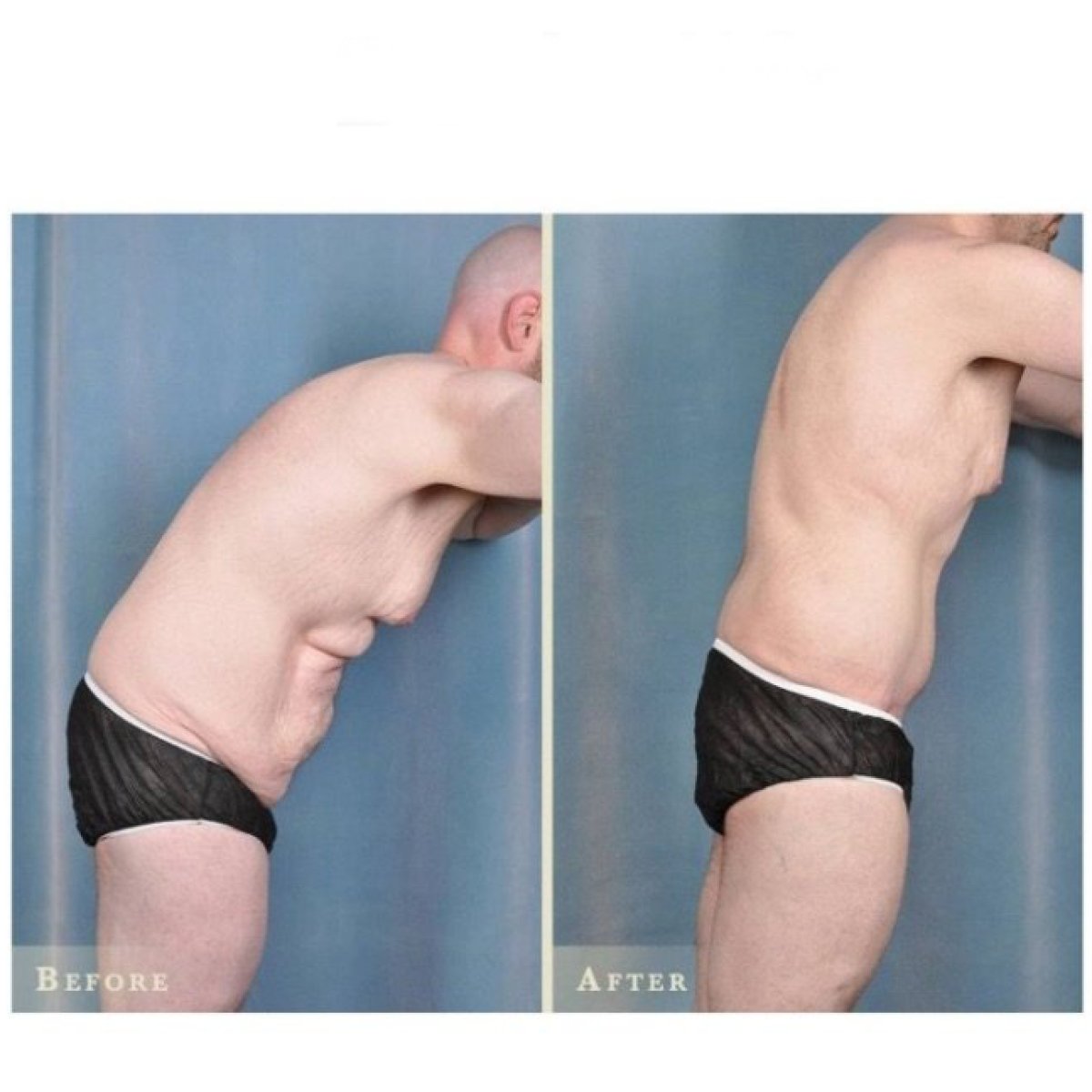 Before and after full body lift results at ID Clinic Bangkok, improved body contour visible