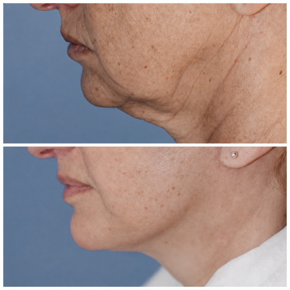 Before and after deep plane facelift at Klinika Promedion, visible jawline and neck lift result