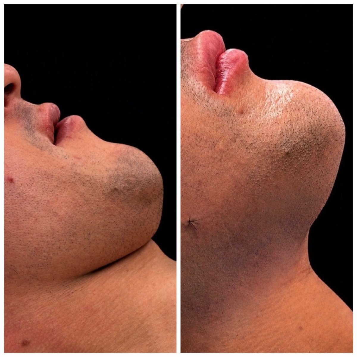 Avant et après génioplastie chez Klinika Promedion, amélioration du contour du menton