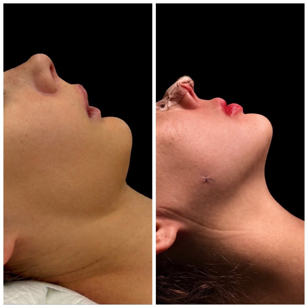 Antes y después de genioplastia deslizante en Klinika Promedion, mejora del contorno de mentón