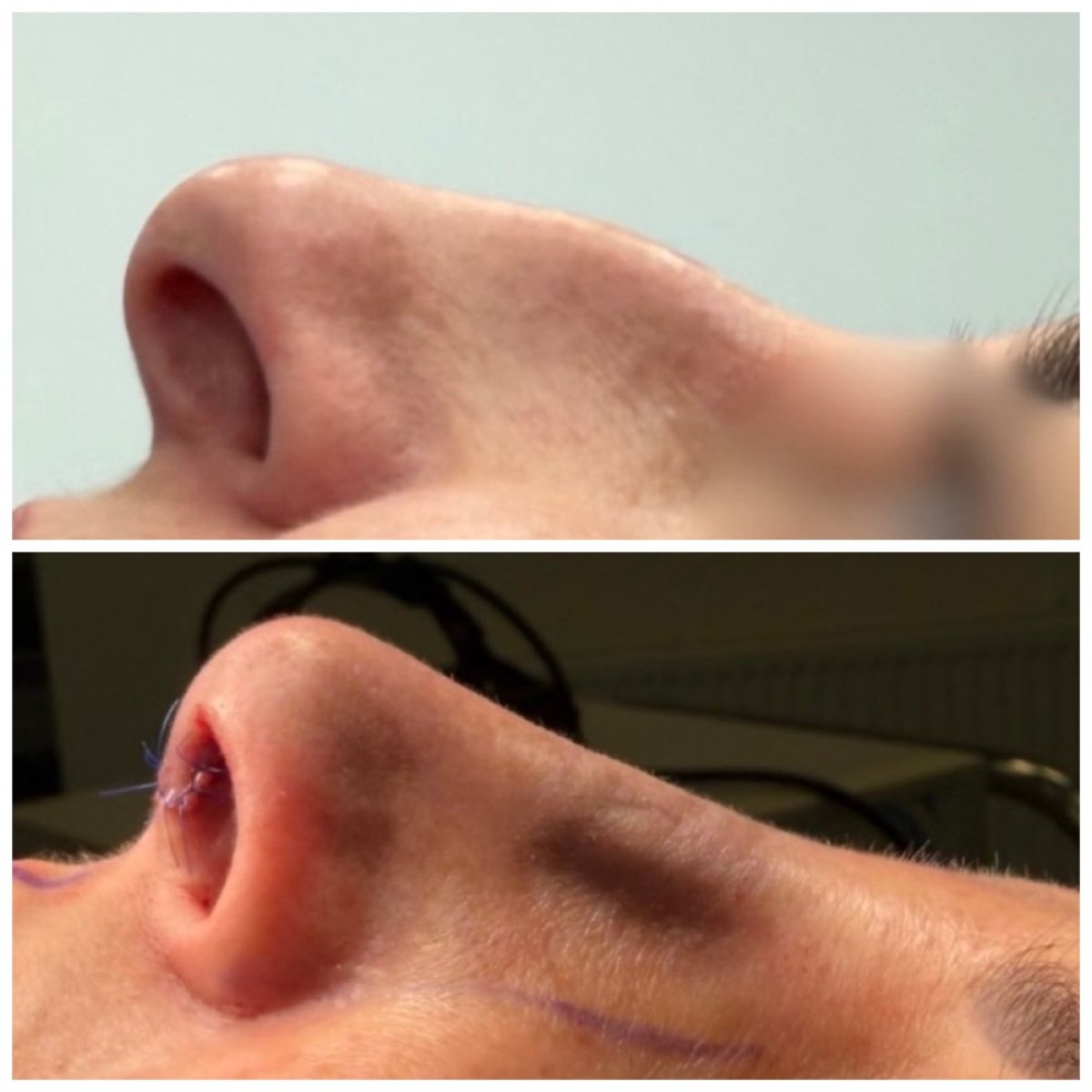 Resultados de rinoplastia antes y después en Klinika Promedion, forma de nariz mejorada