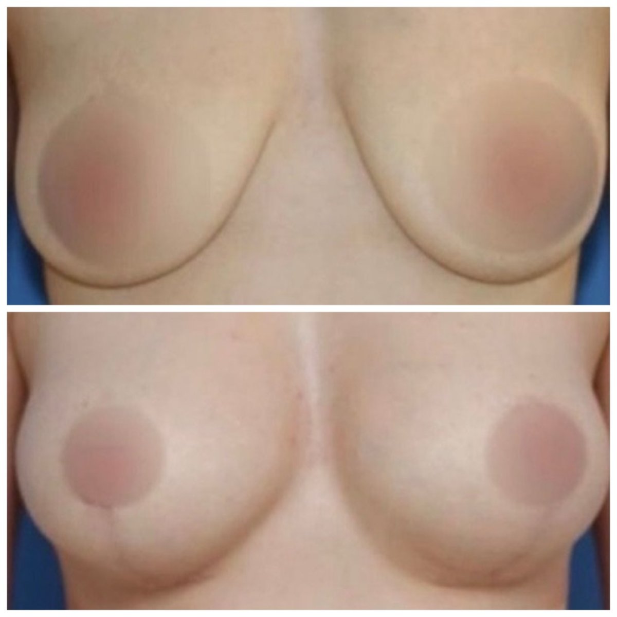 Before and after breast reduction results at Klinika Promedion, improved breast contour