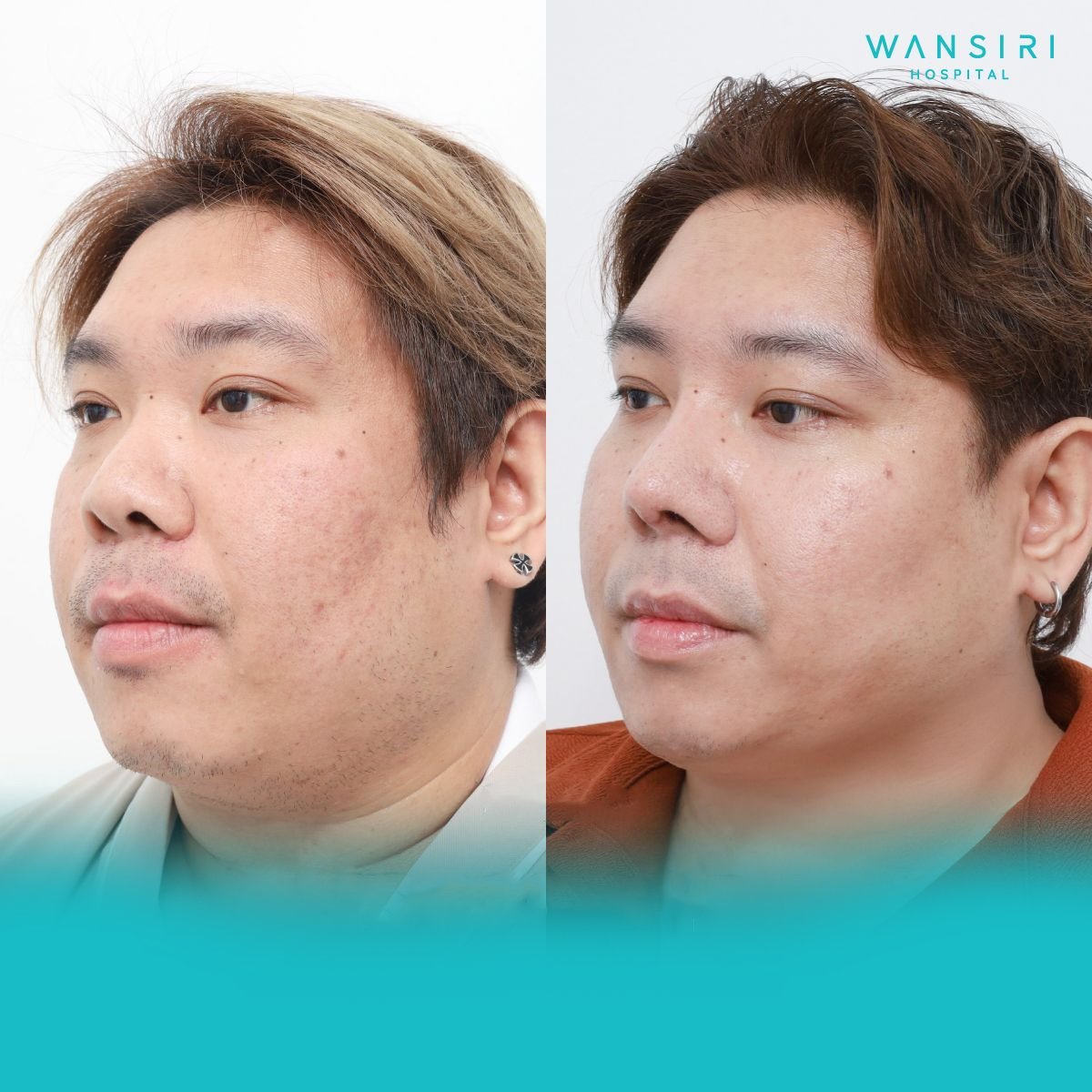 Résultats avant/après liposuccion du menton à Wansiri Hospital, contour amélioré