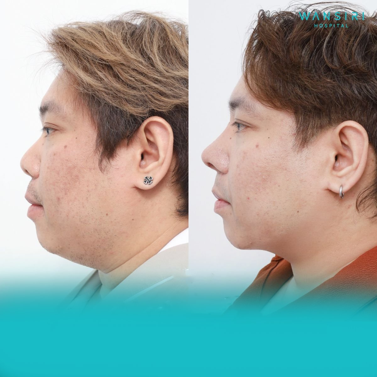 Before and after chin liposuction results at Wansiri Hospital, improved jawline contour