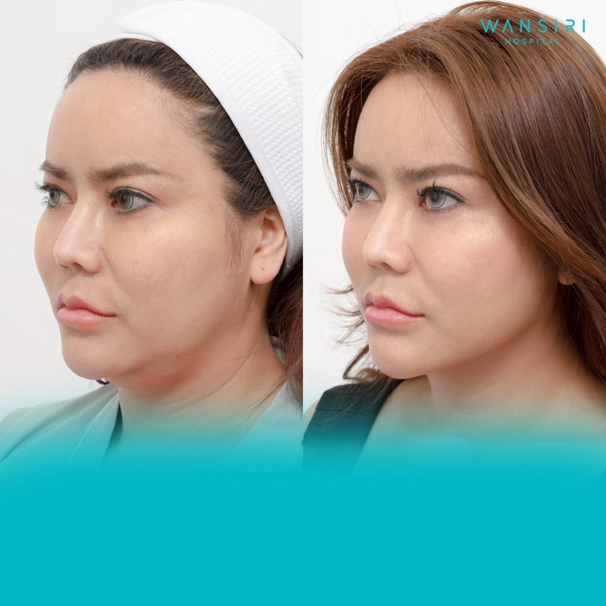 Before and after chin liposuction results at Wansiri Hospital, improved jawline contour