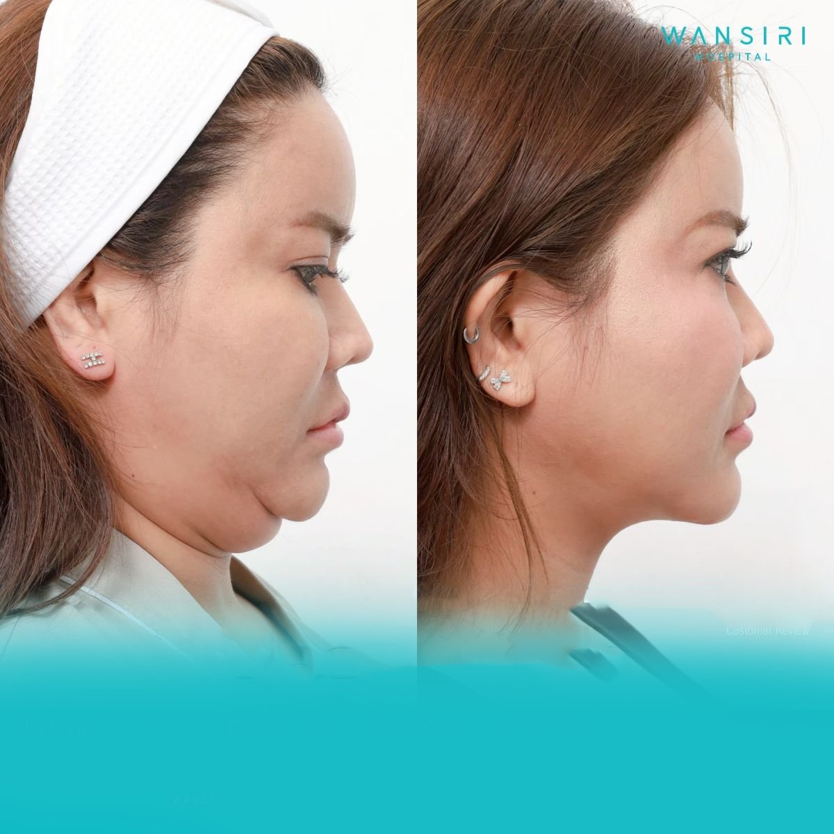 Before and after chin liposuction results at Wansiri Hospital, improved jawline contour