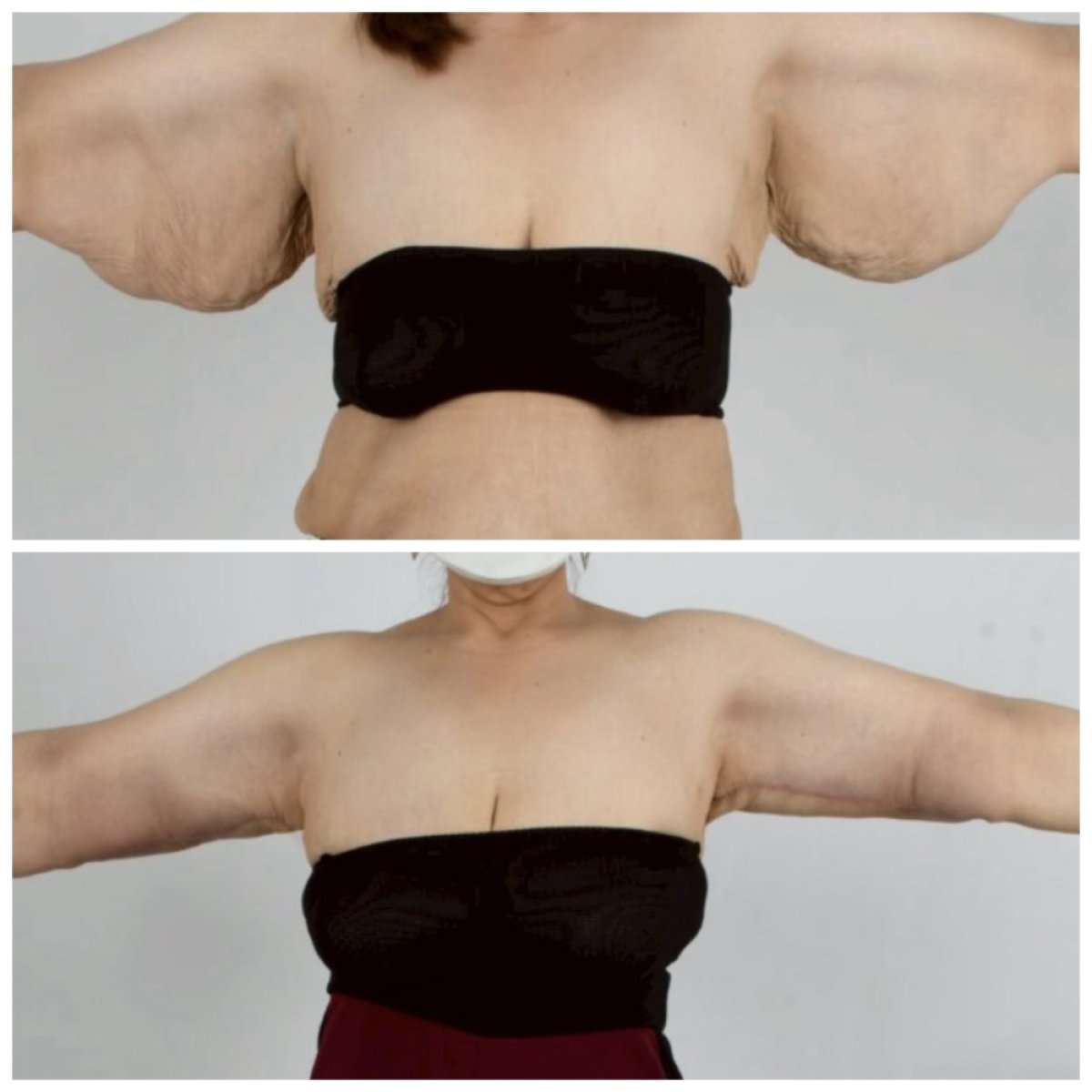 Before and after arm lift (brachioplasty) result at Somchai Clinic, improved arm contour