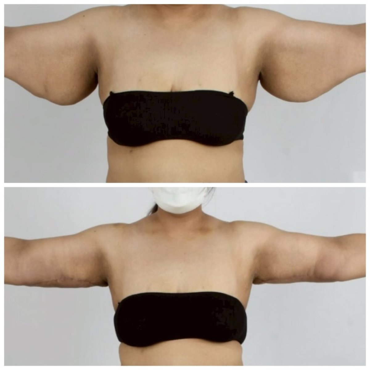 Before and after arm lift (brachioplasty) results at Somchai Clinic, improved arm contour