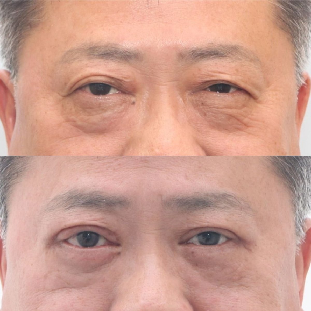 Vorher-nachher-Ergebnis der Blepharoplastik bei Dr. Tak Plastic Surgery, Lidkorrektur