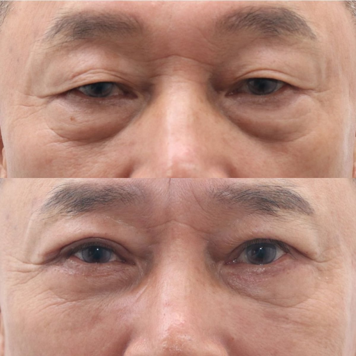 Vorher-nachher-Blepharoplastik-Ergebnisse bei Dr. Tak Plastic Surgery, Lidkorrektur