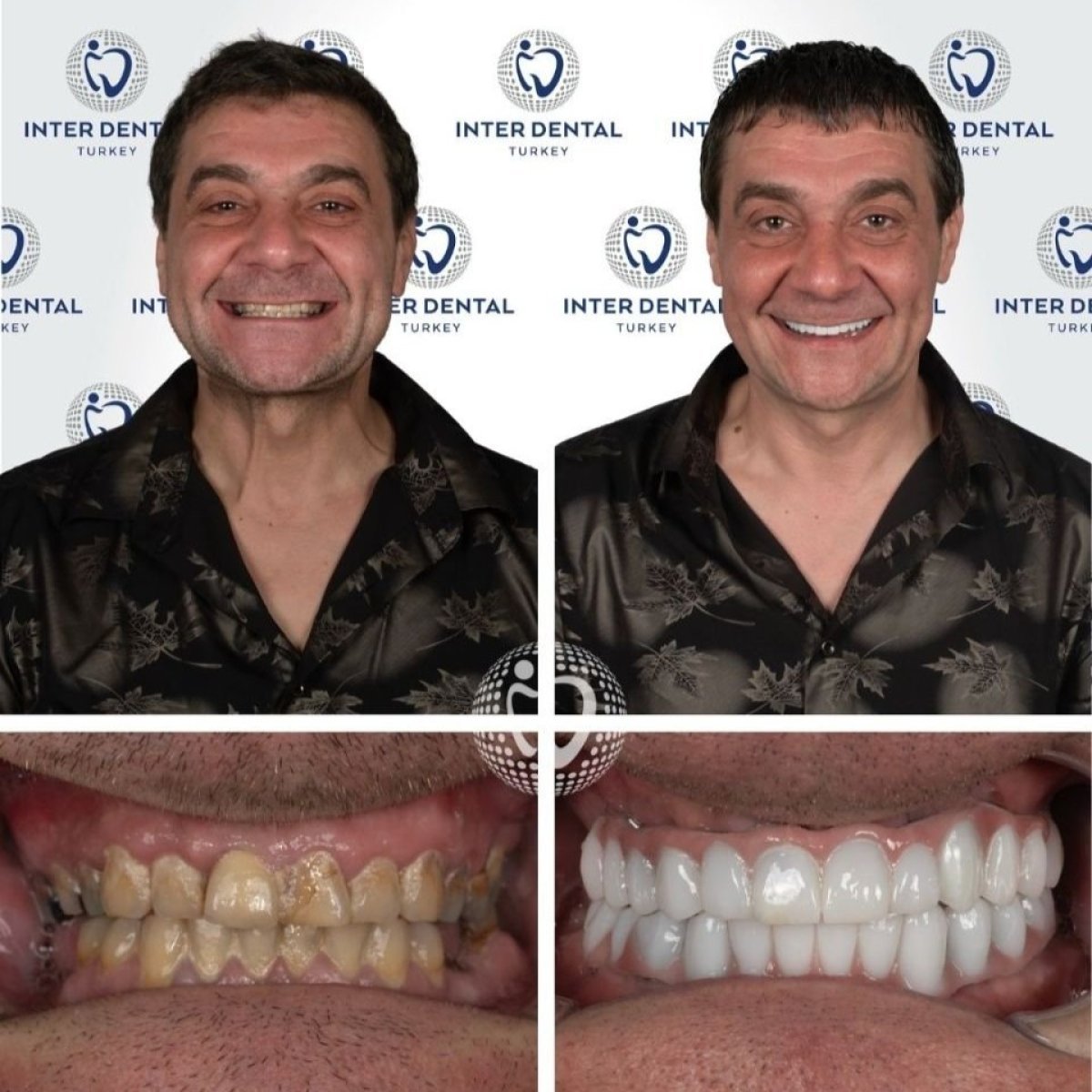 Before and after zirconia crown results at Inter Dental Turkey – smile makeover transformation