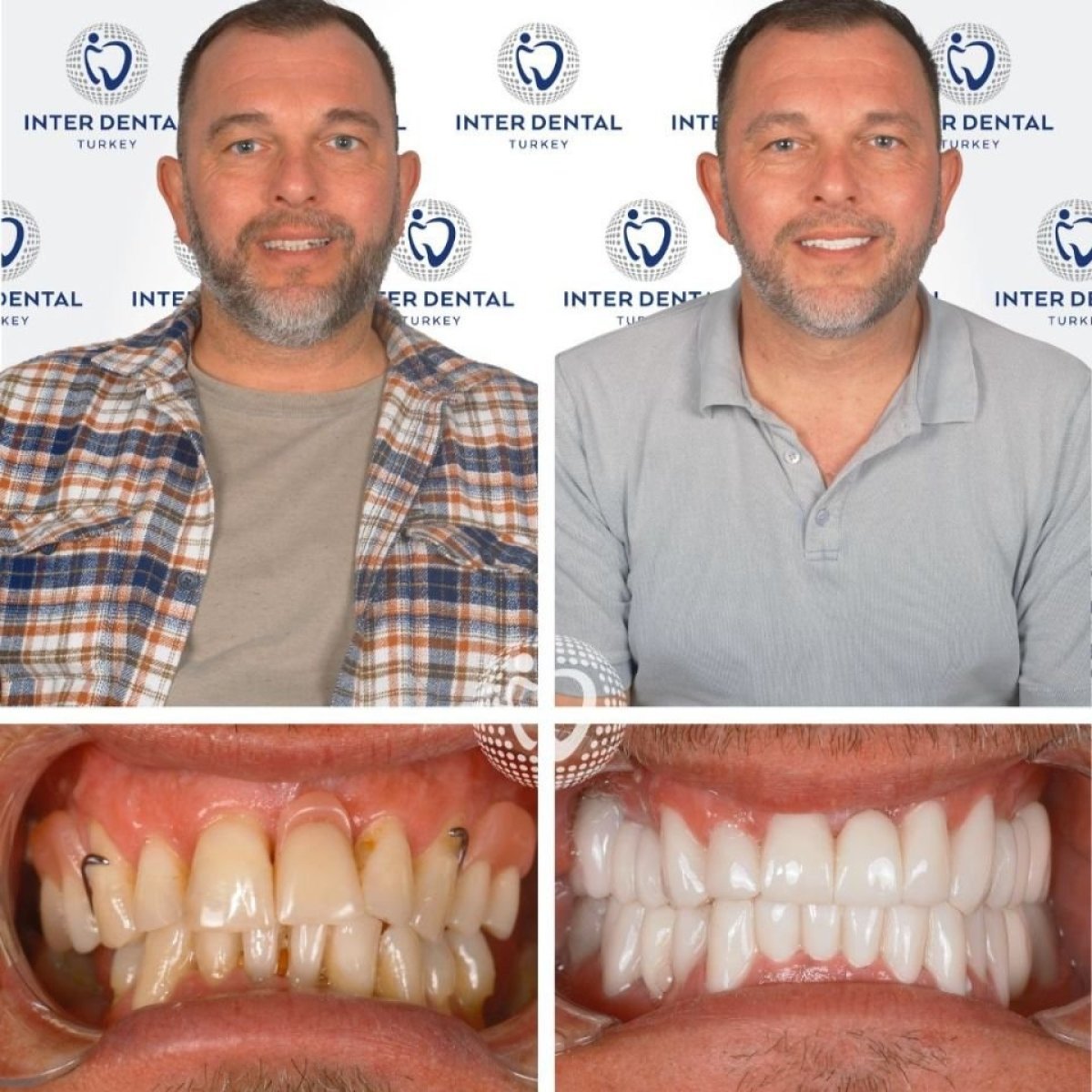 Resultados antes y después de coronas de zirconio en Inter Dental Turkey – transformación de sonrisa