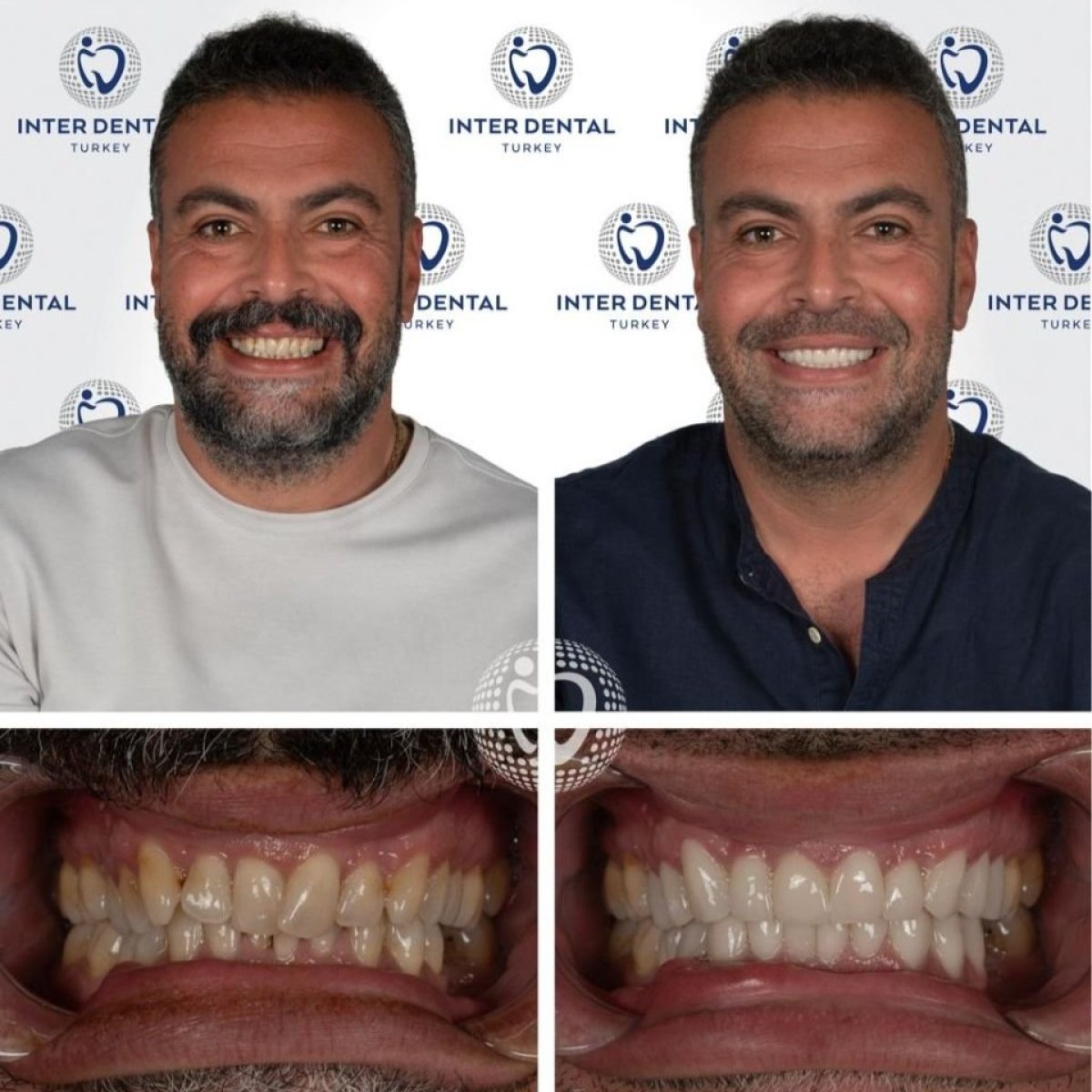 Resultados antes y después de coronas de zirconia en Inter Dental Turkey – sonrisa mejorada