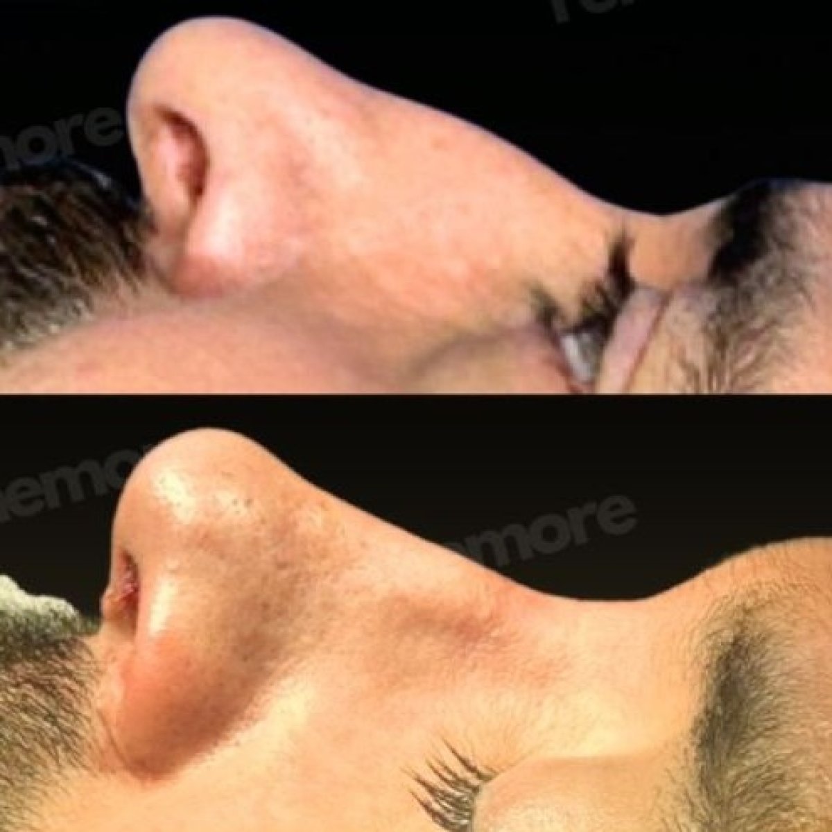 Before and after rhinoplasty results at Memorial Şişli Hospital, improved nose profile