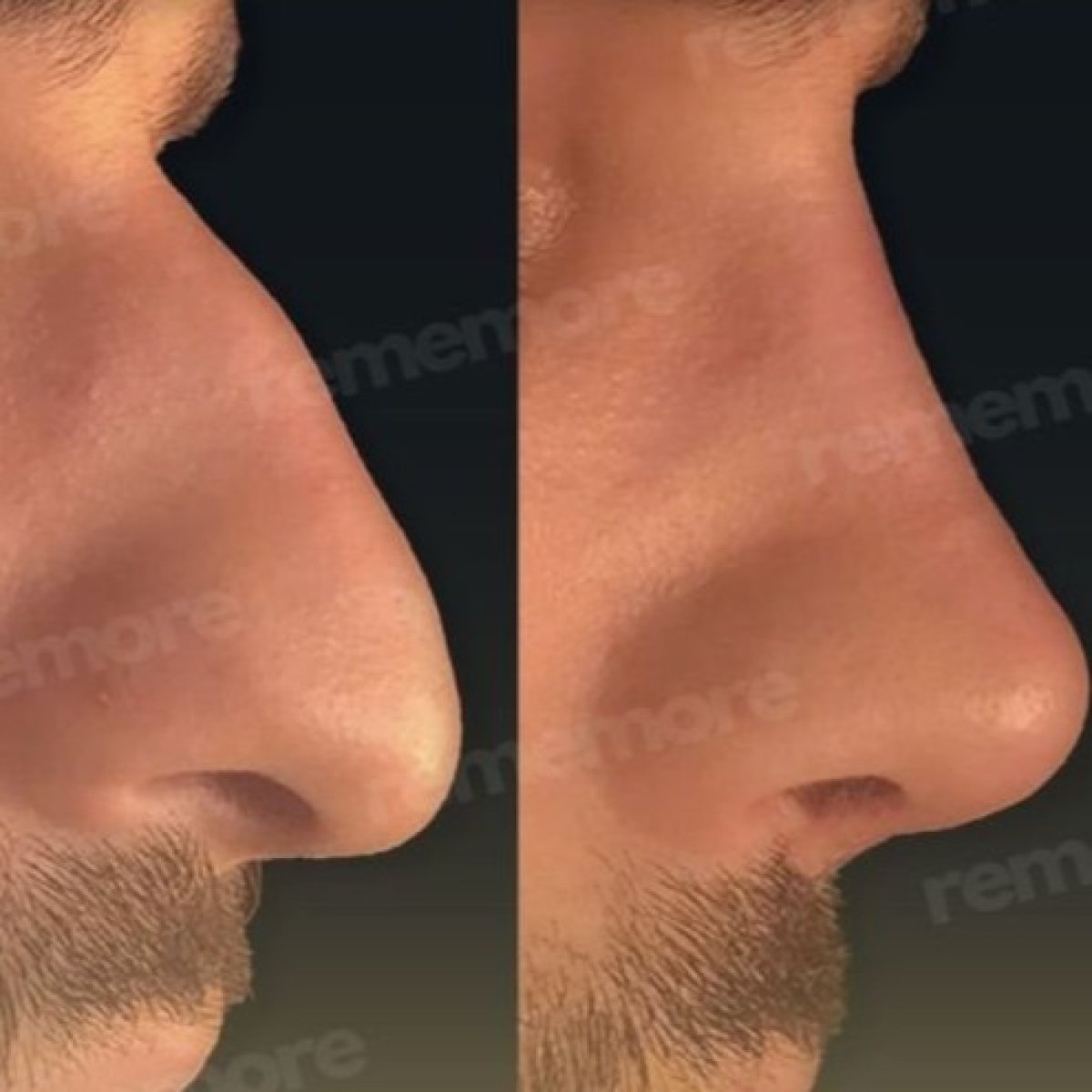 Before and after rhinoplasty results at Memorial Şişli Hospital, improved nose profile