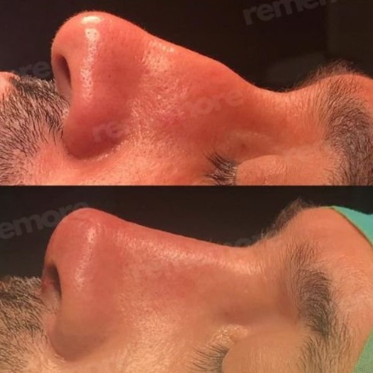 Résultats avant et après rhinoplastie à Memorial Şişli Hospital, profil du nez amélioré