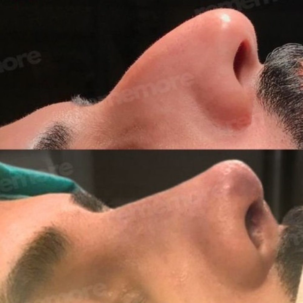 نتائج تجميل الأنف قبل وبعد في مستشفى ميموريال شيشلي، تحسين شكل الأنف