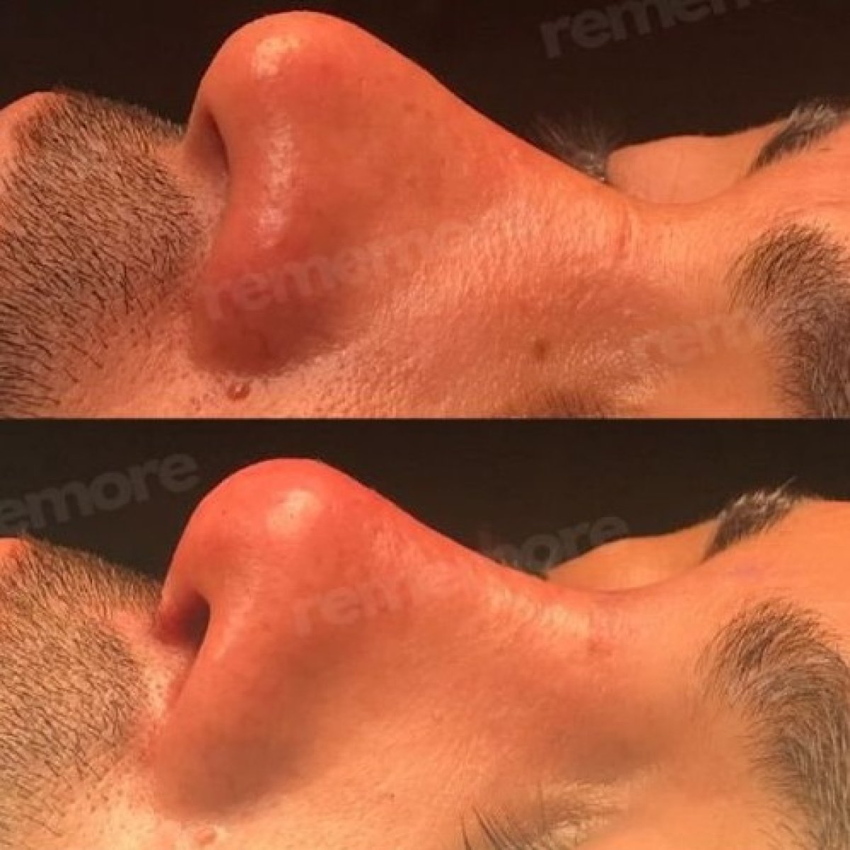 Before and after rhinoplasty result at Memorial Şişli Hospital, improved nose profile