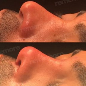 Rhinoplasty by University Professor for Precise, Lasting Results — 5★ Hotel & VIP Transfer Included - photo 5