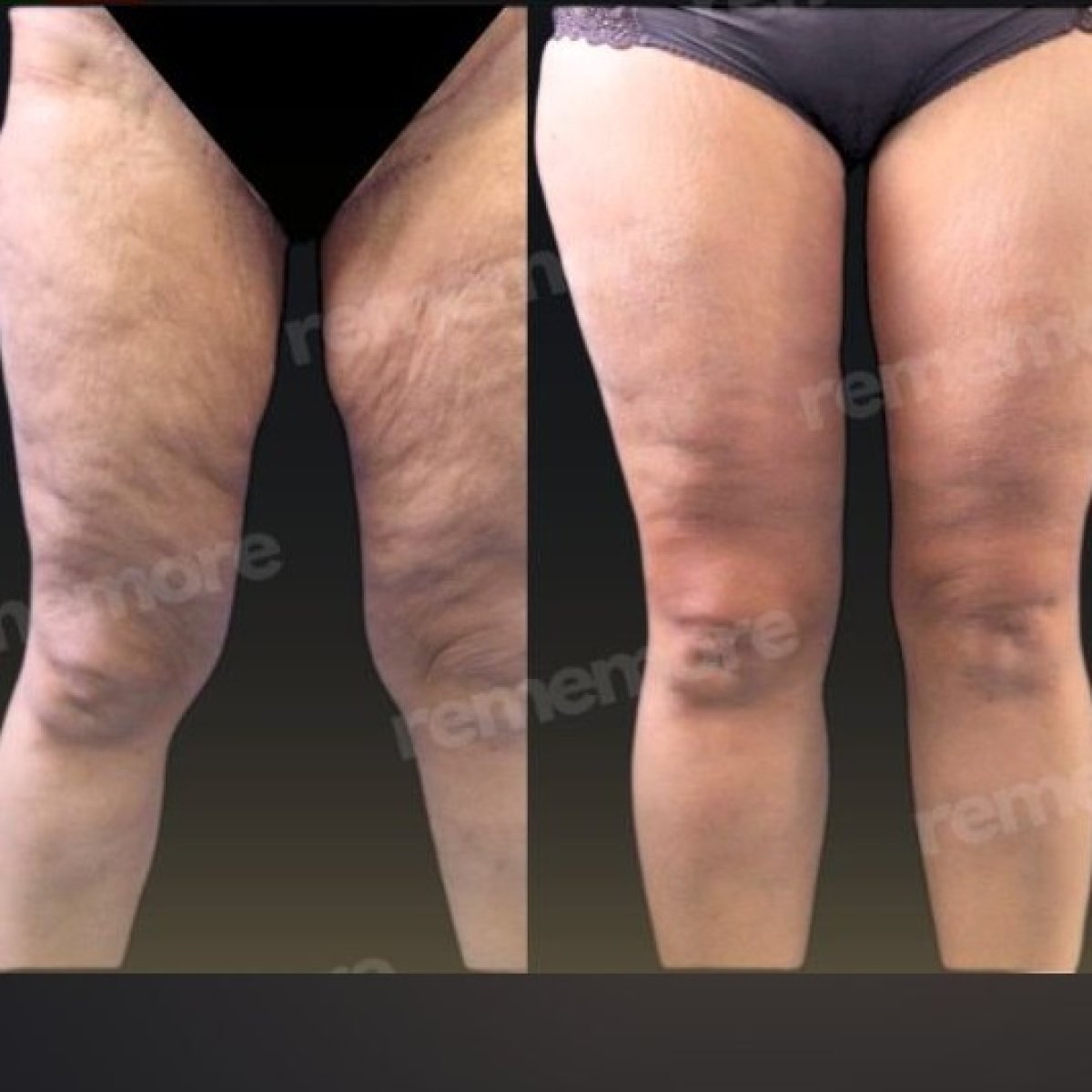 Before and after thigh lift results at Memorial Şişli Hospital, smoother and firmer thighs