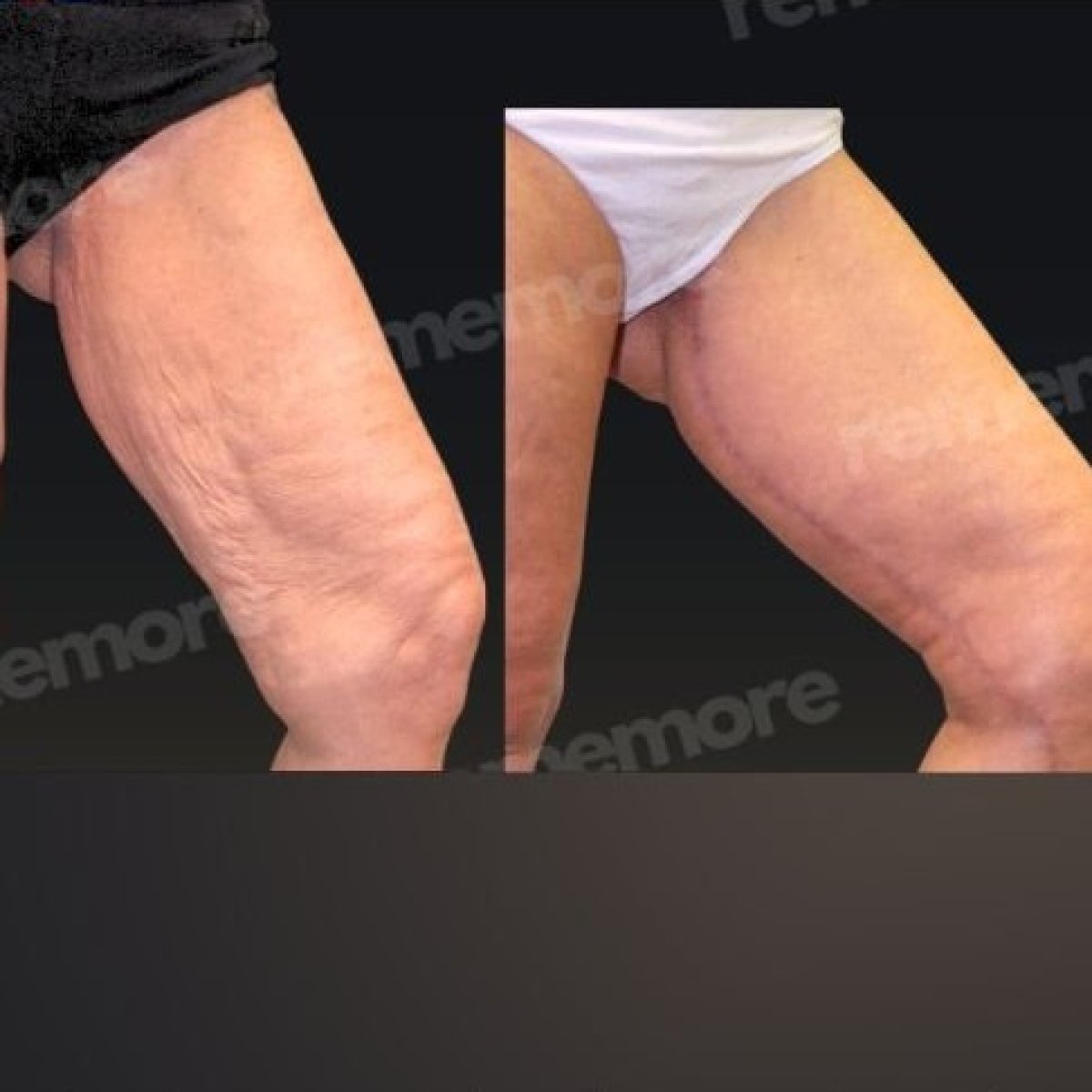 Before and after thigh lift results at Memorial Şişli Hospital, improved leg contour and skin