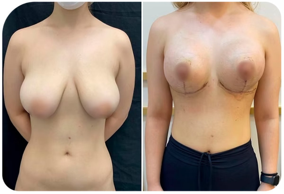 Before and after breast lift results – visible breast contour improvement after surgery