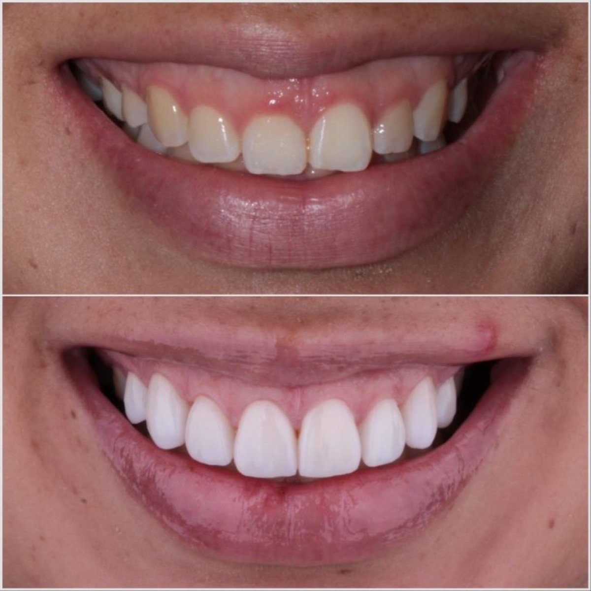 Before and after veneers result – smile transformation with whiter, even teeth
