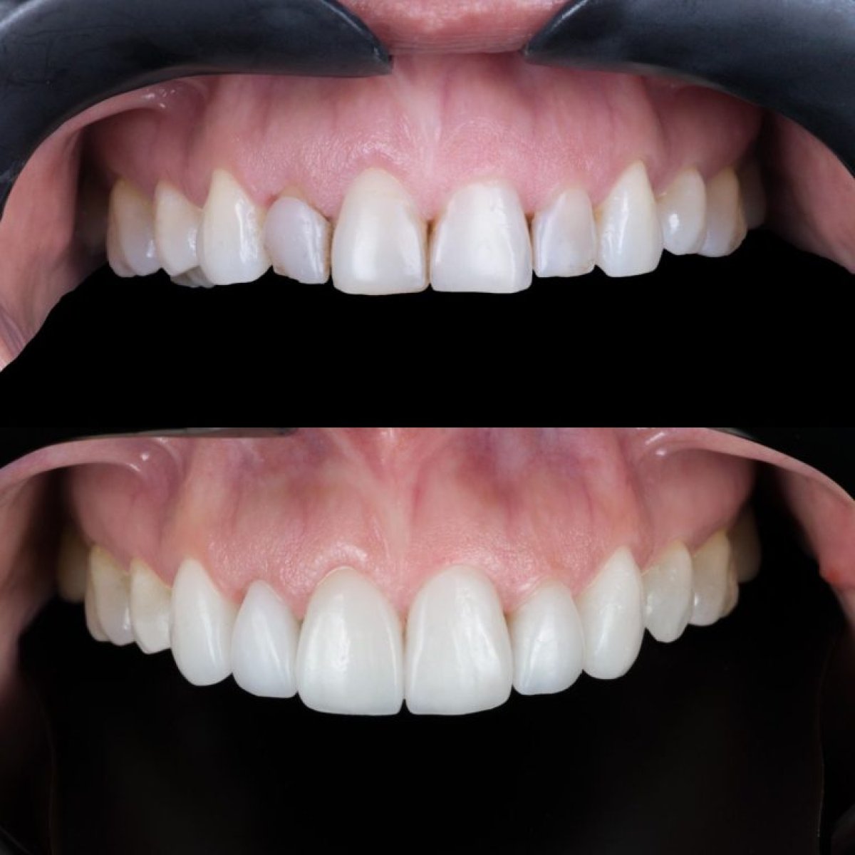 Before and after veneers result – improved smile aesthetics and whiter teeth transformation